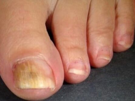 Nagelpilz