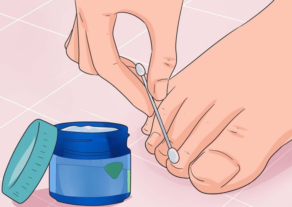 Er kümmert sich um den Nagelpilz
