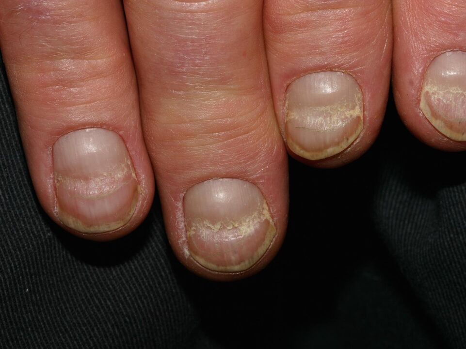 Onychoschisis der Nagelplatte